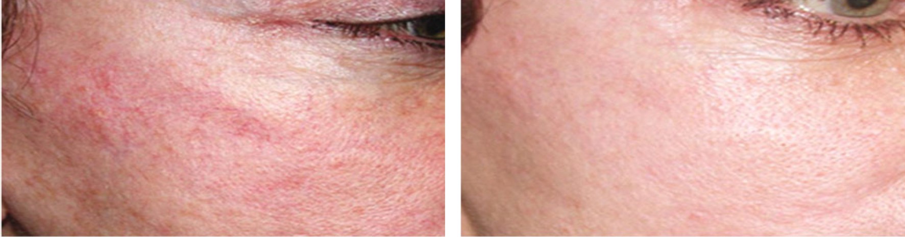 Laser Skin Rejuvenation Image Three