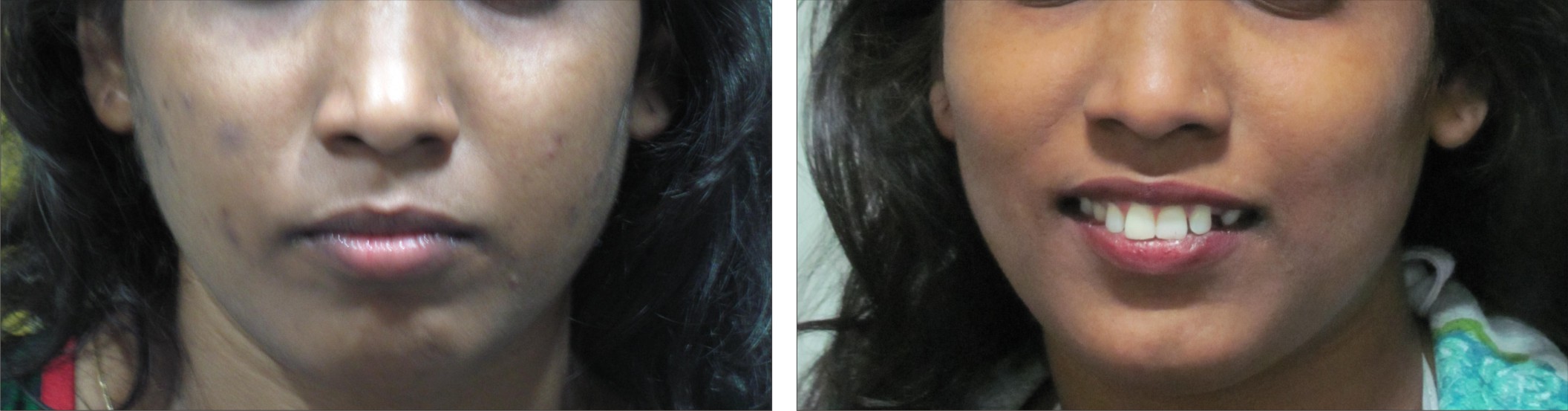 Chemical Peel Image Two