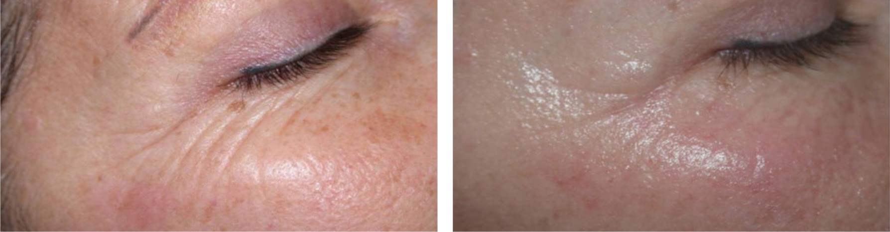 Laser Skin Rejuvenation Image Two