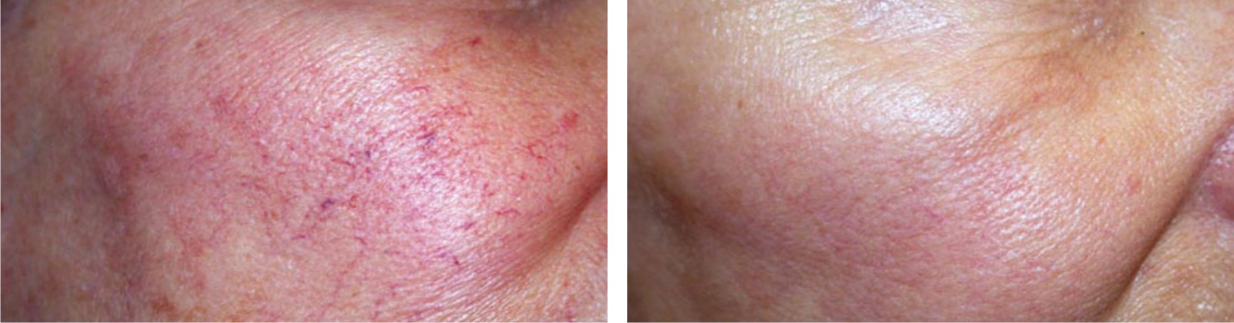 Laser Skin Rejuvenation Image One