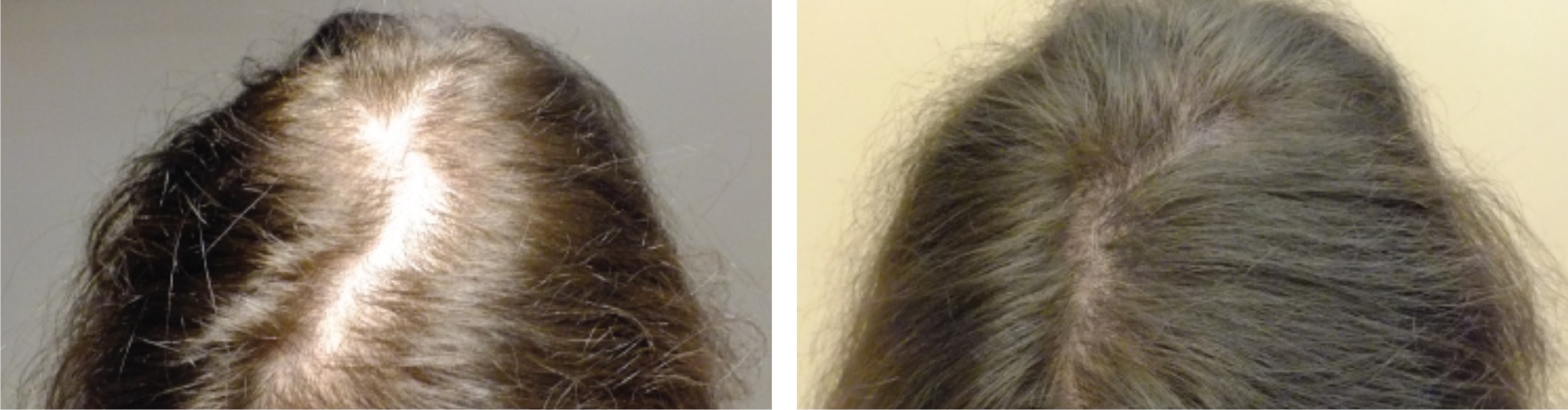 Hair Fall Image Two