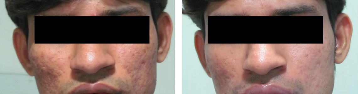Chemical Peel Image Four