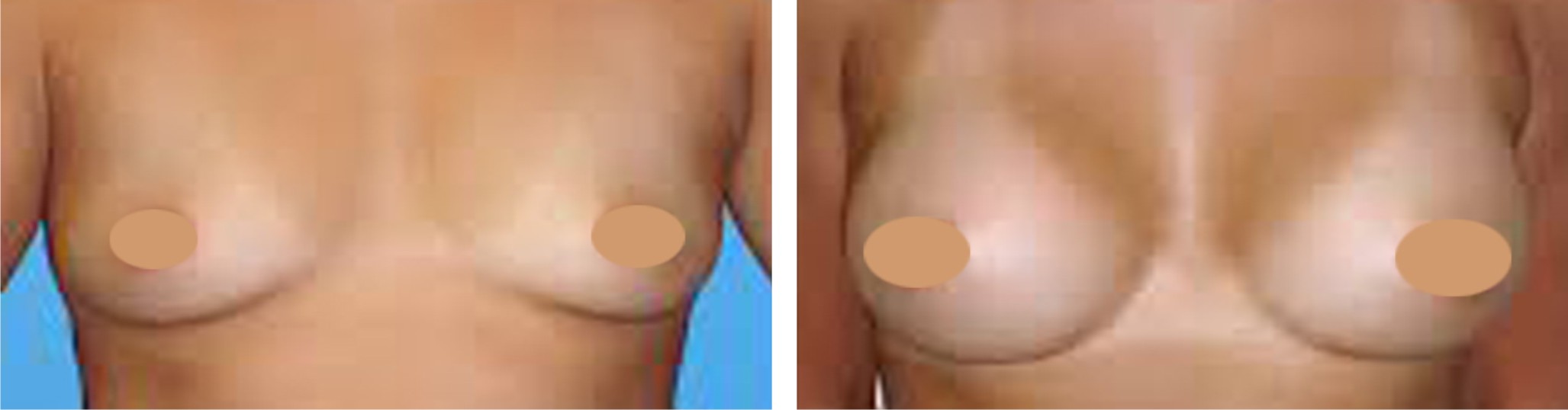 Breast Augmentation Image Two