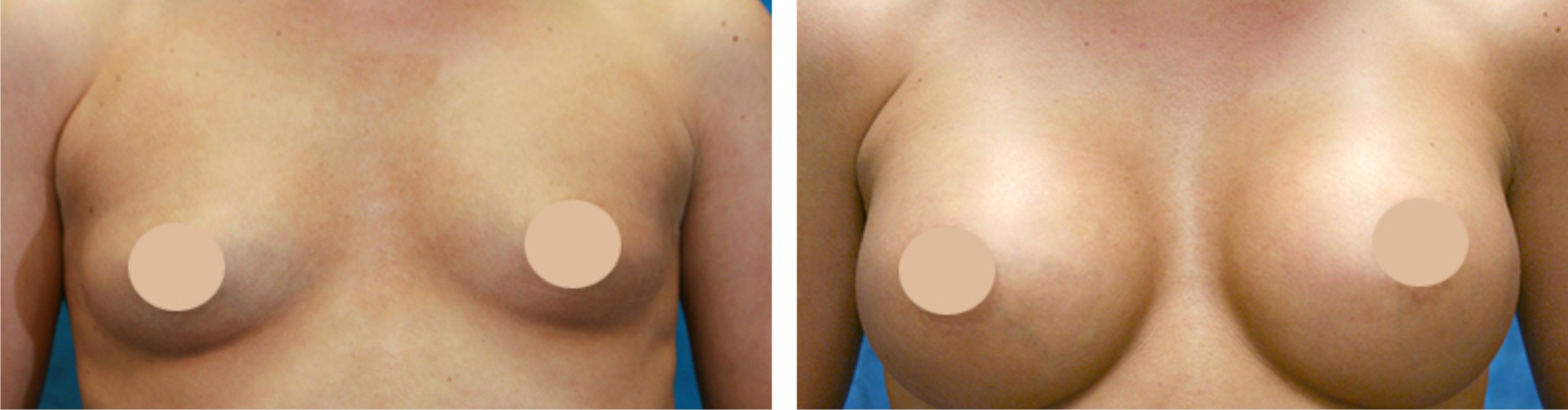 Breast Augmentation Image One