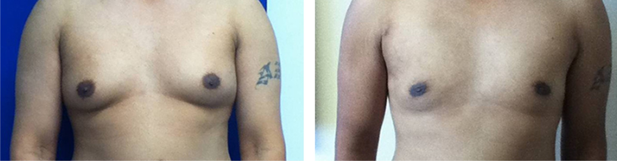 Male Breast Reduction Image Two