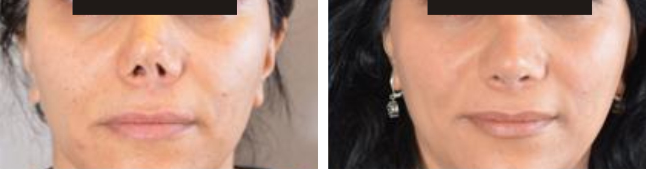 Nose Reshaping Image Two