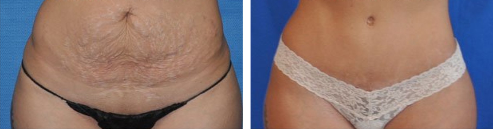 Tummy Tuck Image Two