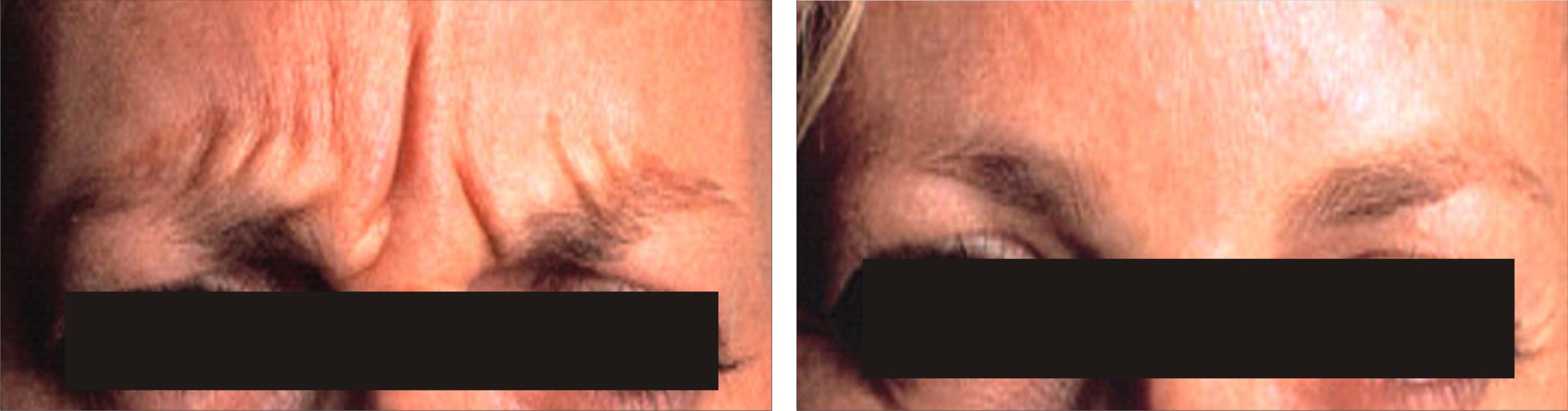 Botulinum Toxin A Image Two