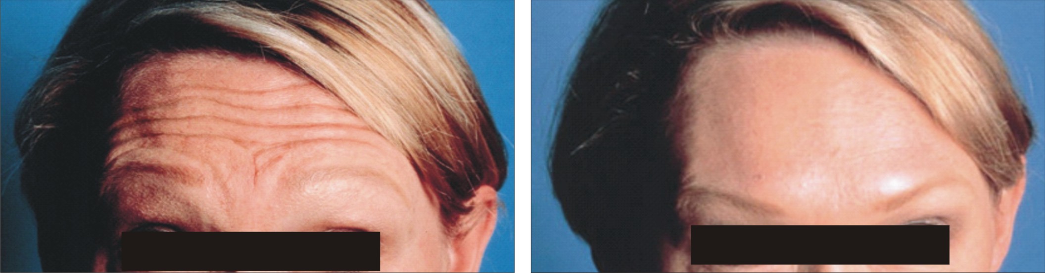 Botulinum Toxin A Image One