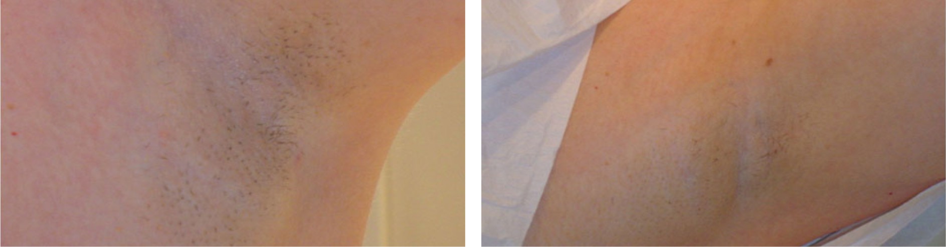 Laser Hair Removal Image Three