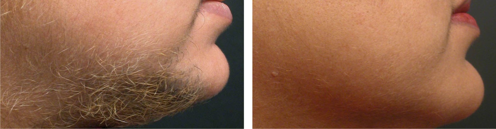 Painless Laser Hair Removal Image One