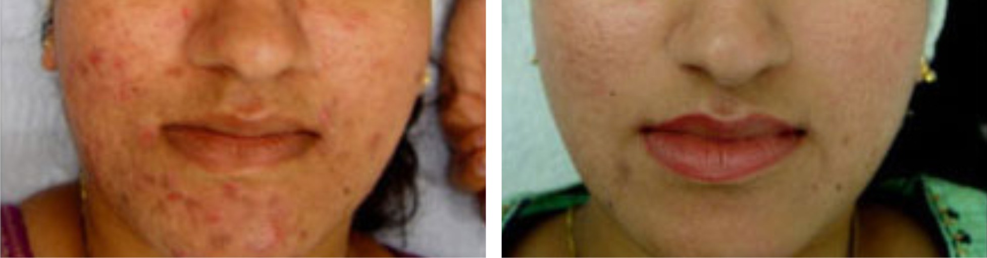 Microdermabrasion Image Two