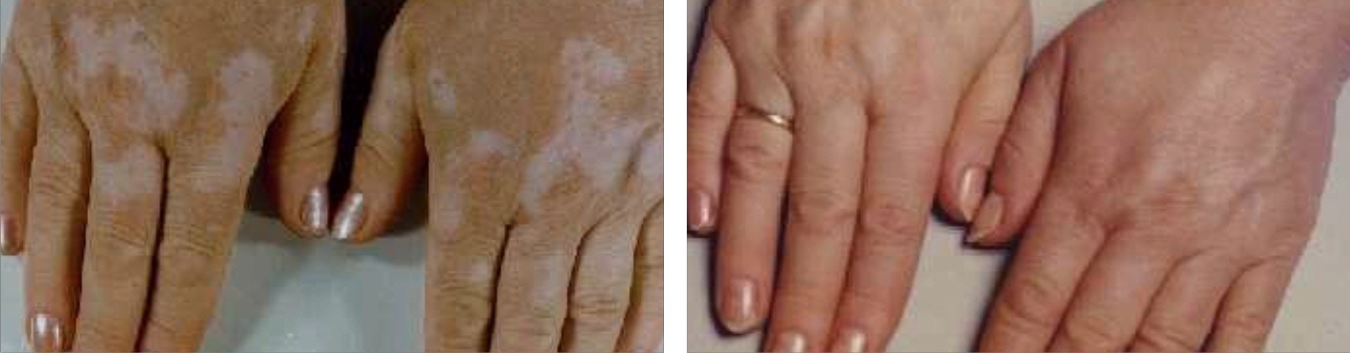 Vitiligo Image Two