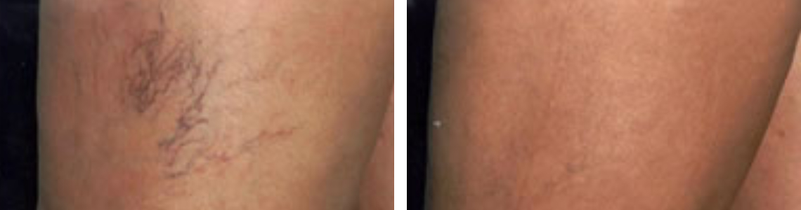 Laser Vein Removal Image Two