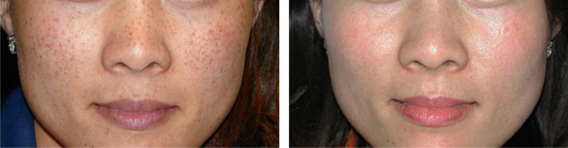 Laser Freckle Removal Image Two