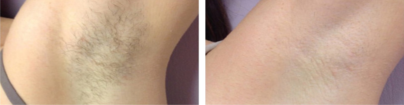 Painless Laser Hair Removal Image Three