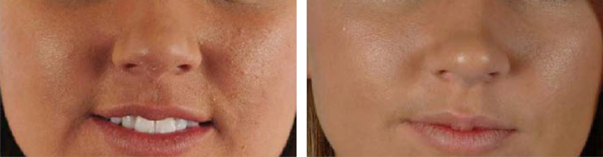Microdermabrasion Image One