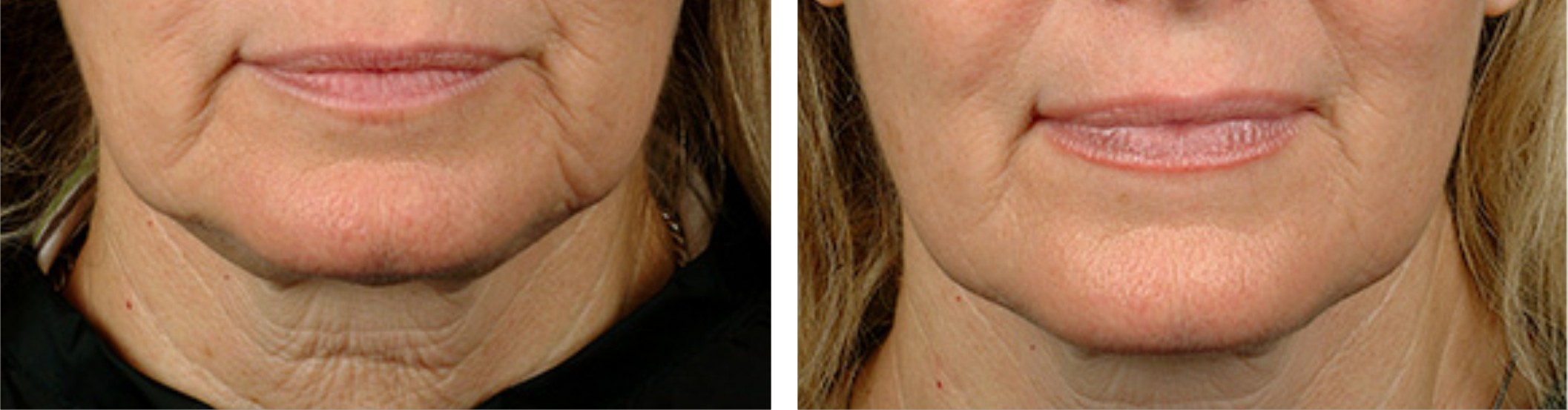 Radio Frequency Skin Tightening (RF) Image Two