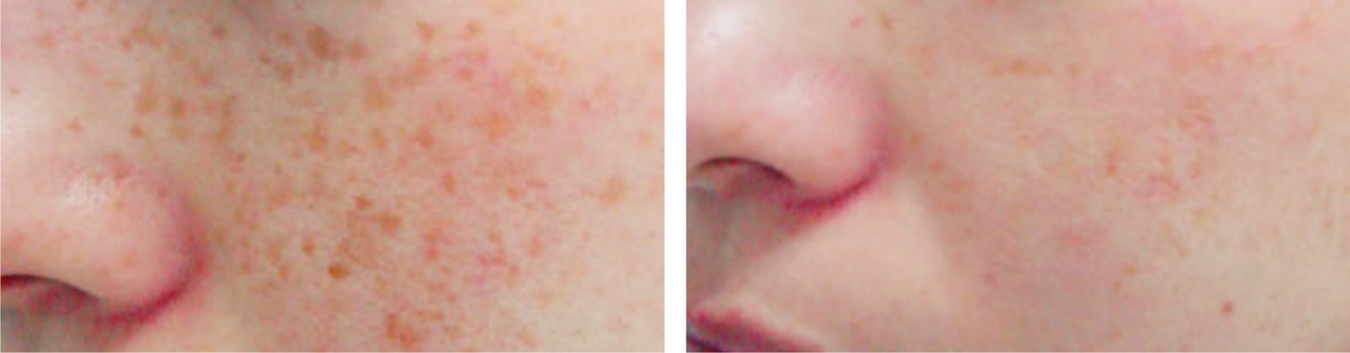 Laser Freckle Removal Image Four