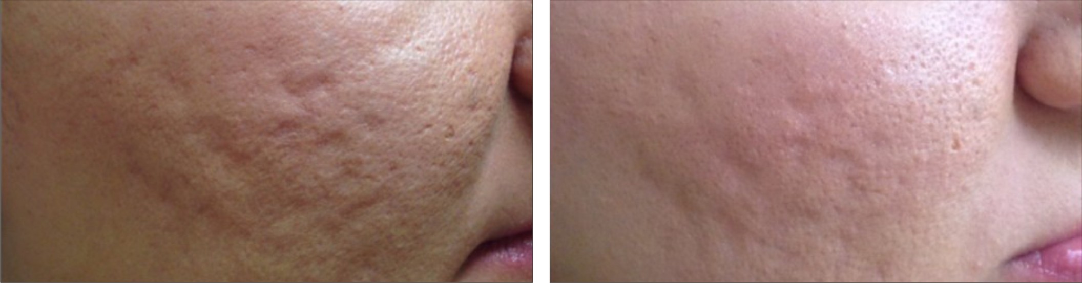 Collagen Induction Therapy Image One