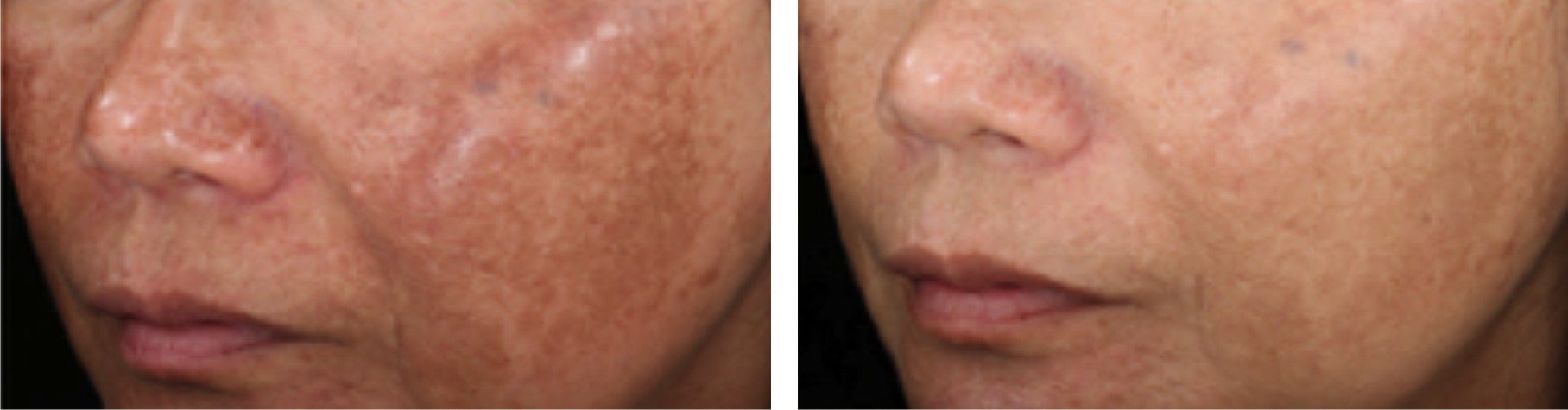 Laser Skin Whitening Image Two