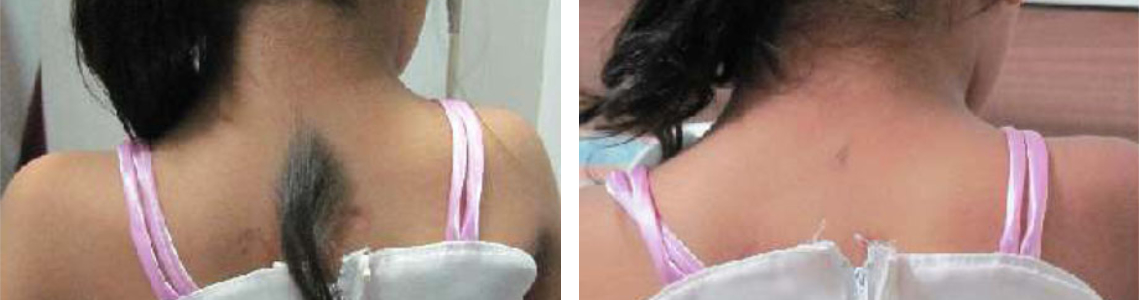 IPL Hair Removal Image One