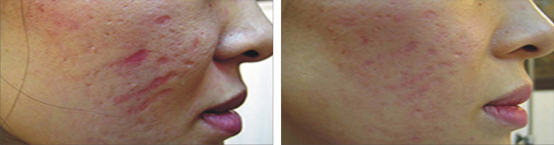Collagen Induction Therapy Image Two