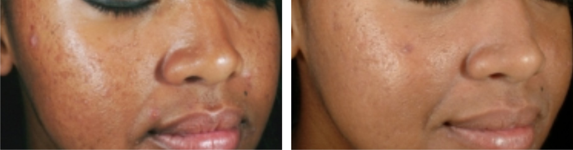 Laser Skin Whitening Image Three