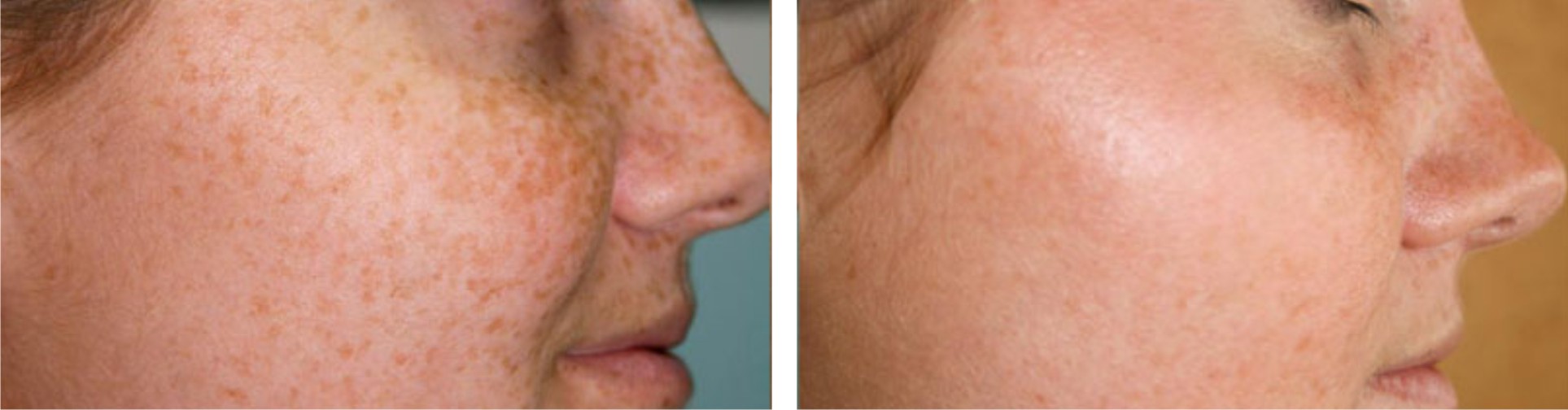 Laser Freckle Removal Image Three