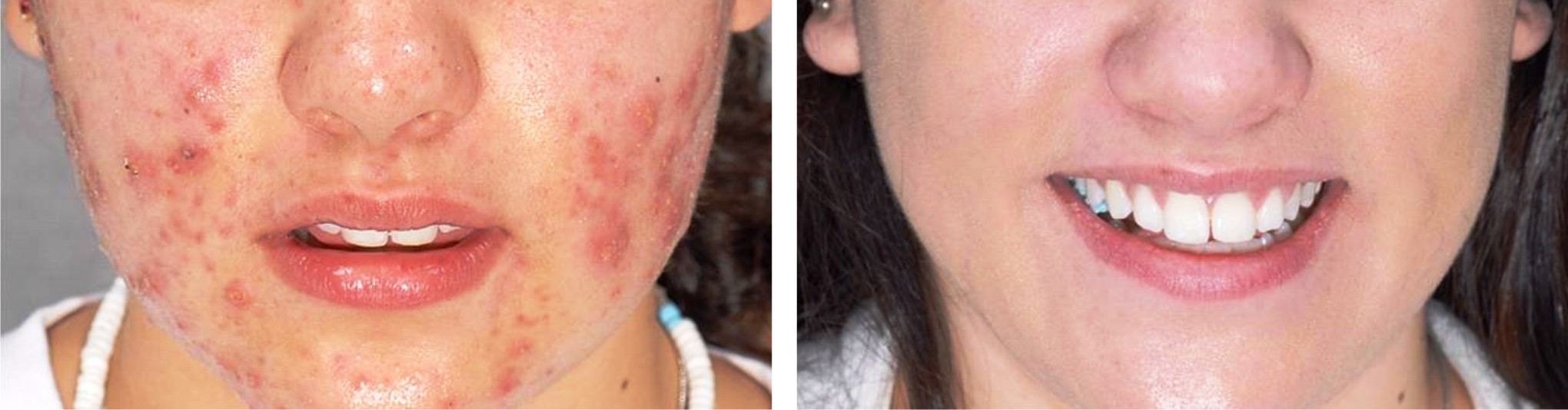 Laser Acne Scar Removal Image One