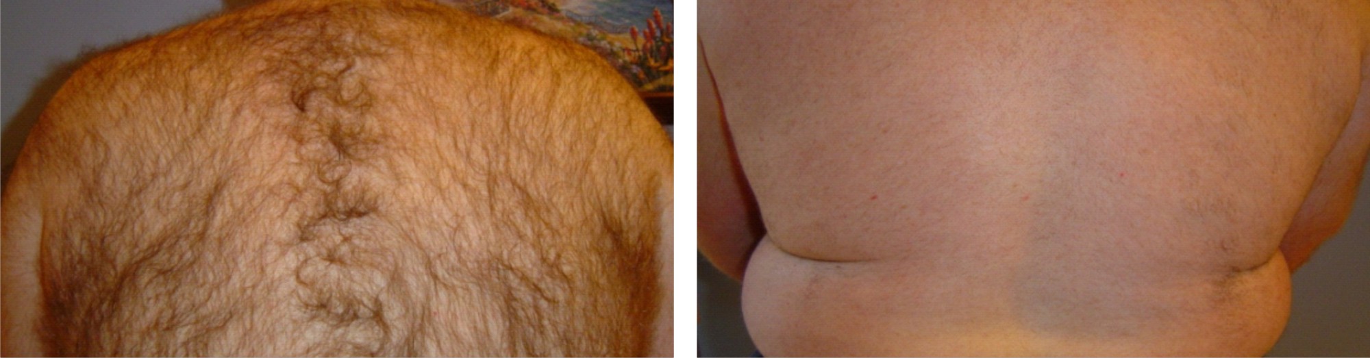 IPL Hair Removal Image Two