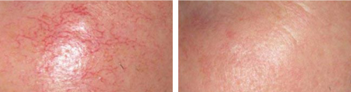 Laser Broken Capillaries Removal Image Two