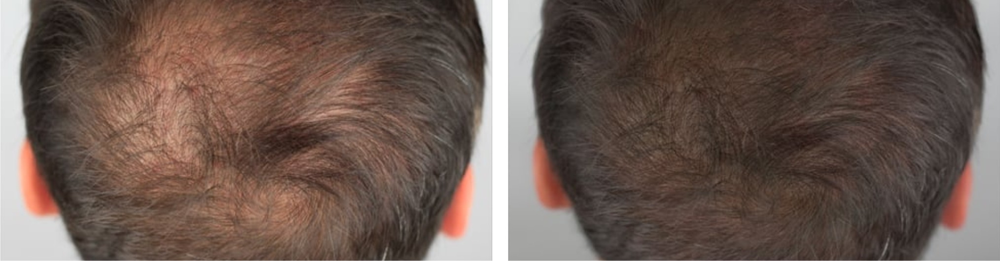 Hair Follicle Simulation Image Three